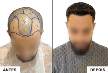 Antes e Depois Transplante Capilar