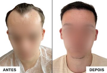 Antes e Depois Transplante Capilar