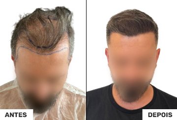 Antes e Depois Transplante Capilar