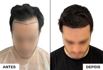 Antes e Depois Transplante Capilar