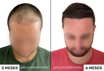 Antes e Depois Transplante Capilar