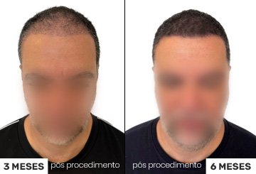 Antes e Depois Transplante Capilar